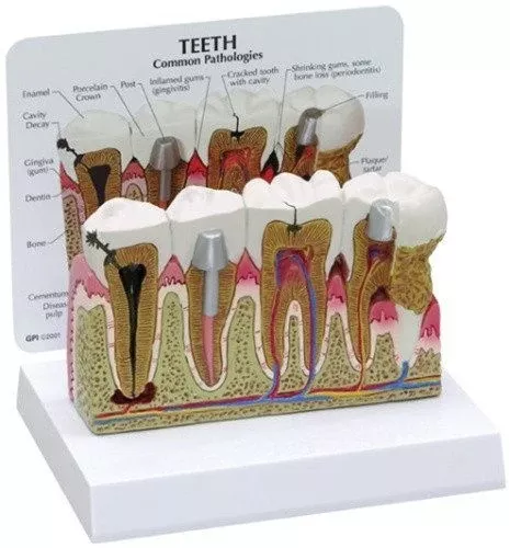 Diseased Teeth and Gums Model