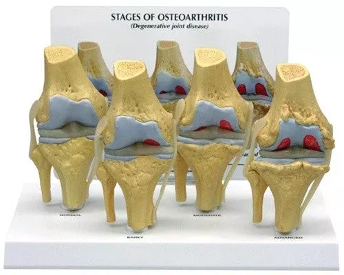 Four Stages of Osteoarthritis Model in The Knee Joint