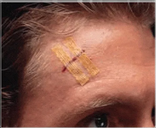 Steri-Strips Antimicrobial Skin Closures ½” x 4”
